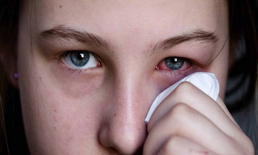 தமிழகத்தை மிரட்டும் ‘மெட்ராஸ் ஐ’!. மின்னல் வேகத்தில் பரவும் கண் நோய்!. தப்புவது எப்படி? Madras Eye