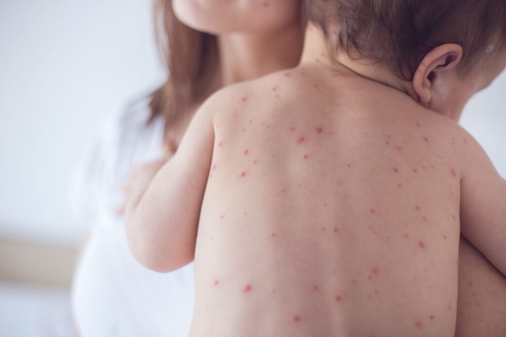 Measles Spreading
